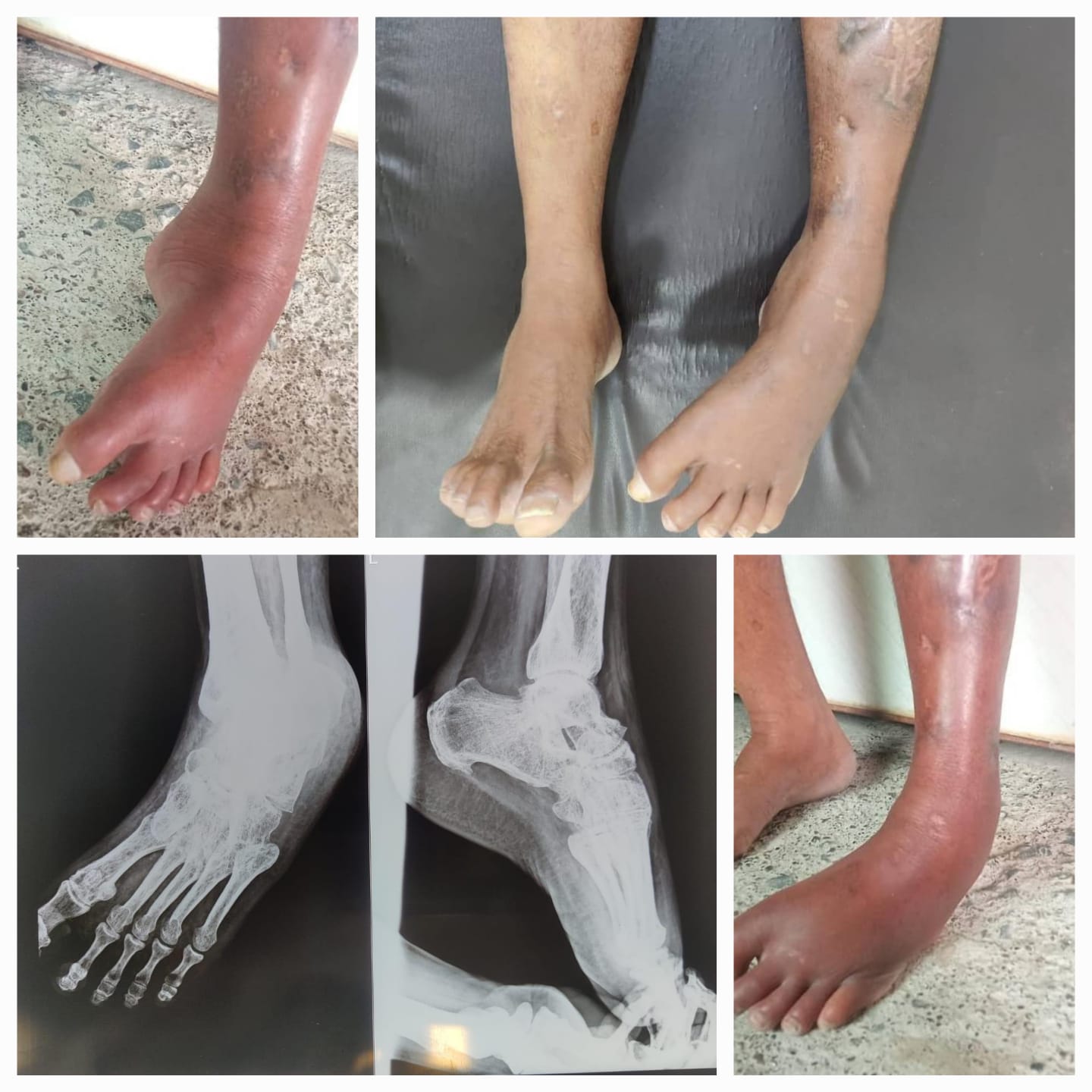 SPECIAL TREATMENTS FOR FOOT & ANKLE